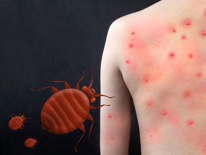 bedbug bites